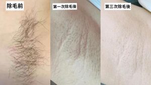 Read more about the article 【北投美容】Vi’s Beauty 秋天來除毛毛吧！
 秋冬除毛毛效果更好！？
 低溫會減慢黑色…