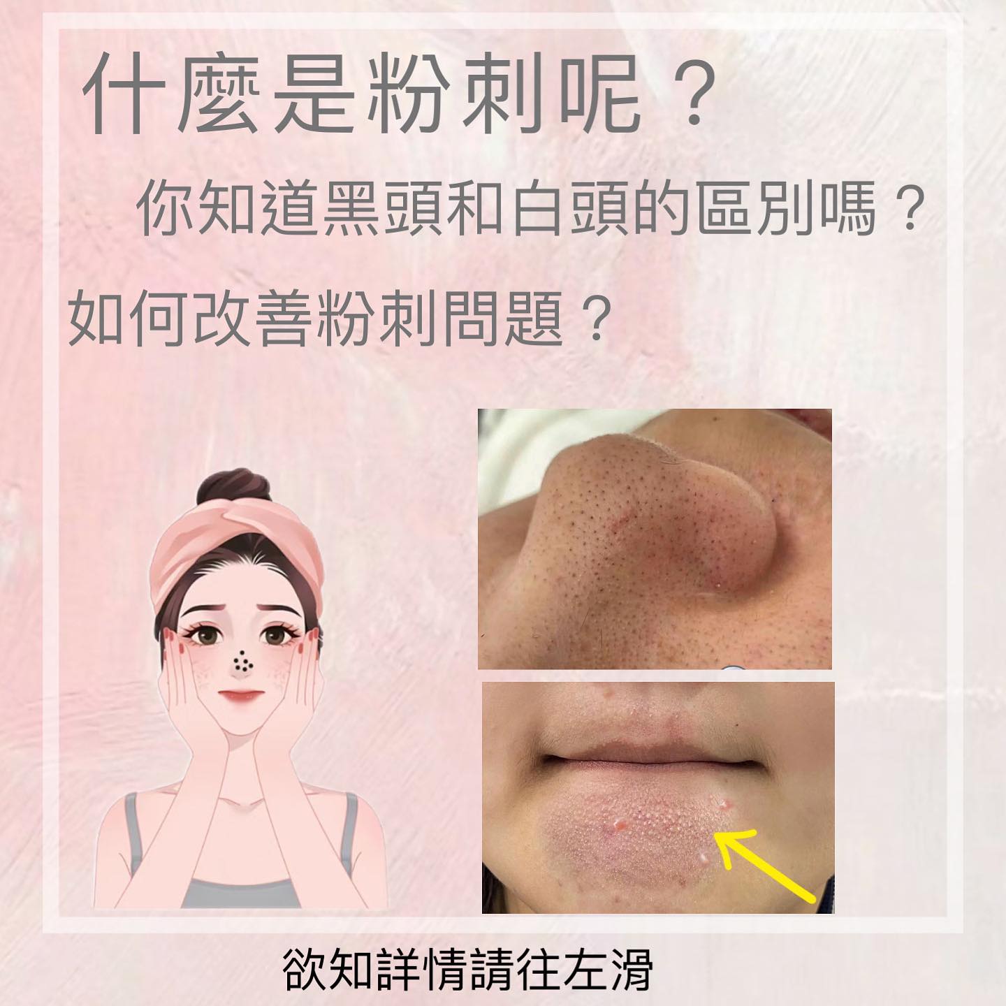 You are currently viewing 【北投美容】Vi’s Beauty 相信有很多甜心不知道黑頭白頭是怎麼形成的
 小姊姊今天就來幫…