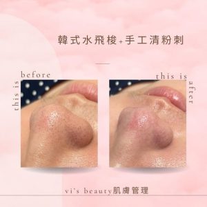 Read more about the article 【北投美容】Vi’s Beauty 深層清潔
 每個月都要堅持深層清潔一次，
 粉刺黑頭和白頭不…