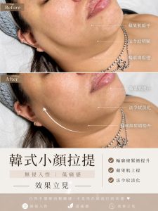 Read more about the article 【北投美容】Vi’s Beauty 不是修圖，是輪廓真的上來了

韓式小顏拉提
無侵入性｜低痛感…