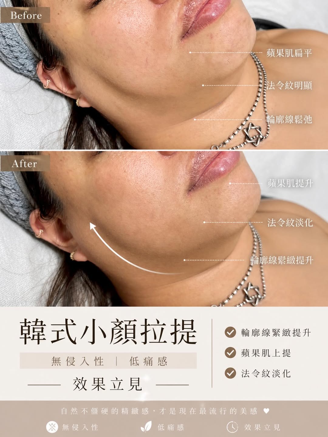 You are currently viewing 【北投美容】Vi’s Beauty 不是修圖，是輪廓真的上來了

韓式小顏拉提
無侵入性｜低痛感…