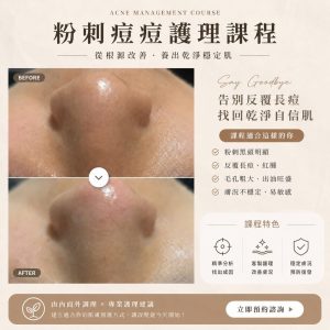 Read more about the article 【北投美容】Vi’s Beauty 毛孔粗大、粉刺反覆長
其實不是清不乾淨，而是肌膚早就在發出警…