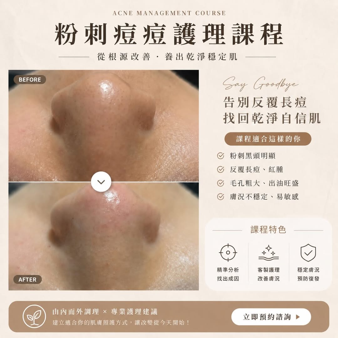 You are currently viewing 【北投美容】Vi’s Beauty 毛孔粗大、粉刺反覆長
其實不是清不乾淨，而是肌膚早就在發出警…